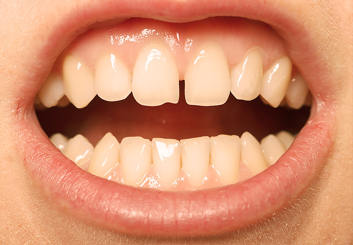 Dentes com diastema
